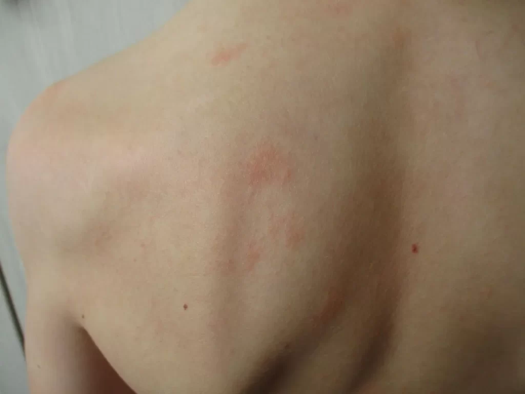 Tinta de tatuaje que causa alergia en la piel