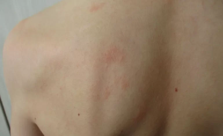 Cómo identificar una reacción alérgica a las tintas de tatuaje
